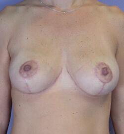 Breast Reduction (for Women) Before & After Image