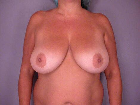 Breast Reduction (for Women) Before & After Image