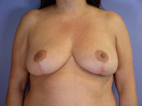 Breast Reduction (for Women) Before & After Image