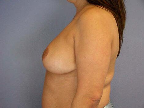 Breast Reduction (for Women) Before & After Image