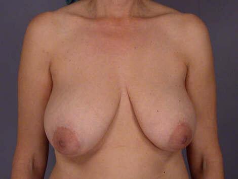 Breast Reduction (for Women) Before & After Image