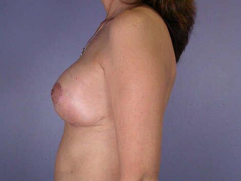 Breast Reduction (for Women) Before & After Image