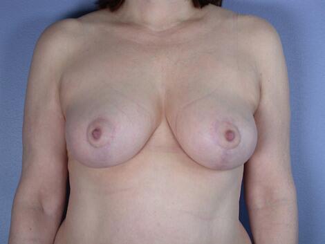 Breast Reduction (for Women) Before & After Image