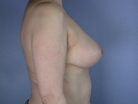 Breast Reduction (for Women) Before & After Image