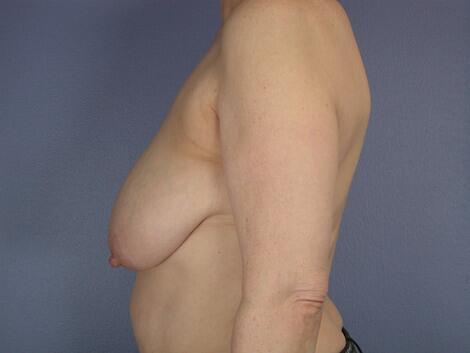 Breast Reduction (for Women) Before & After Image