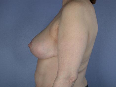 Breast Reduction (for Women) Before & After Image