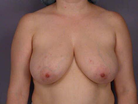 Breast Reduction (for Women) Before & After Image