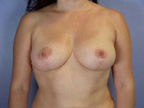 Breast Reduction (for Women) Before & After Image