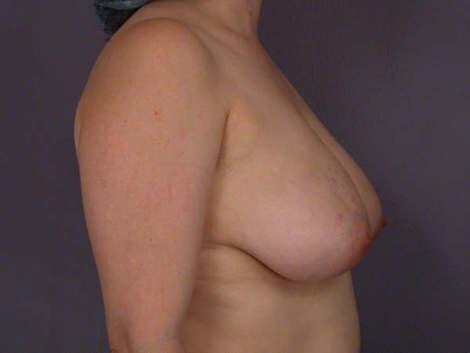 Breast Reduction (for Women) Before & After Image