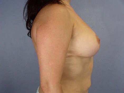 Breast Reduction (for Women) Before & After Image