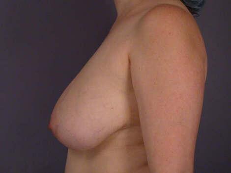 Breast Reduction (for Women) Before & After Image