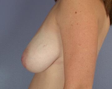 Breast Reduction (for Women) Before & After Image