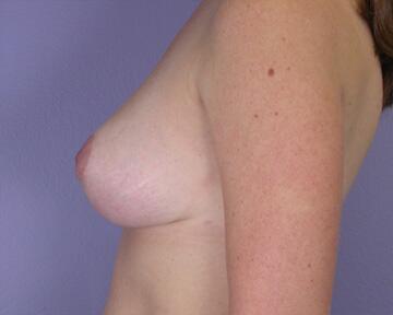 Breast Reduction (for Women) Before & After Image