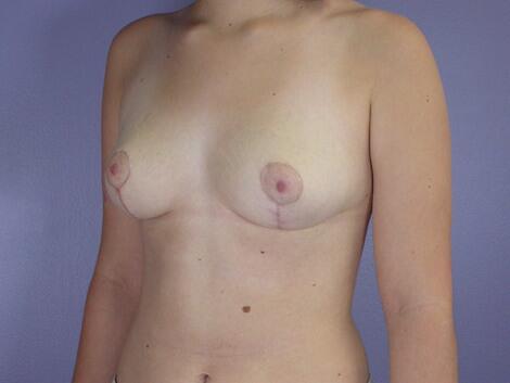 Breast Reduction (for Women) Before & After Image