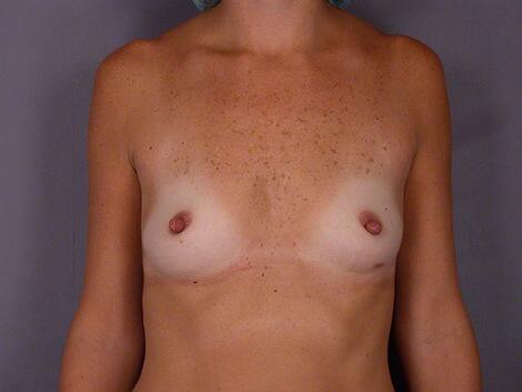 Breast Reduction (for Women) Before & After Image