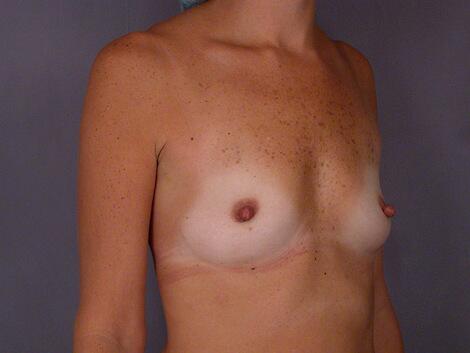 Breast Reduction (for Women) Before & After Image