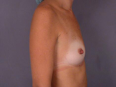 Breast Reduction (for Women) Before & After Image