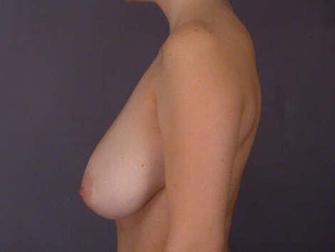 Breast Reduction (for Women) Before & After Image