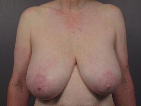 Breast Reduction (for Women) Before & After Image