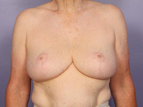 Breast Reduction (for Women) Before & After Image