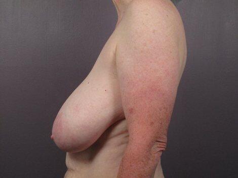 Breast Reduction (for Women) Before & After Image