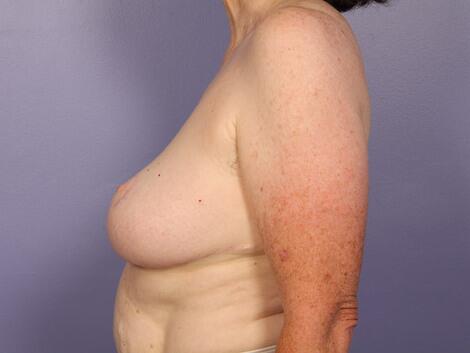 Breast Reduction (for Women) Before & After Image