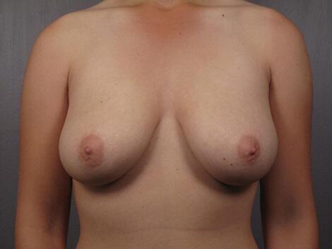 Breast Reduction (for Women) Before & After Image