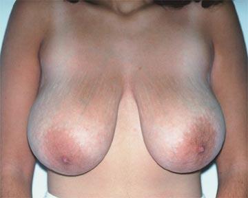 Breast Reduction (for Women) Before & After Image