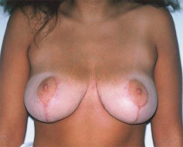 Breast Reduction (for Women) Before & After Image