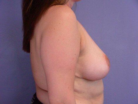 Breast Reduction (for Women) Before & After Image