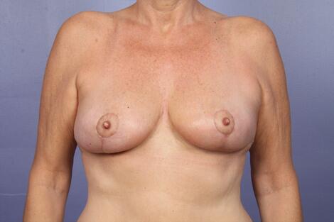 Breast Reduction (for Women) Before & After Image