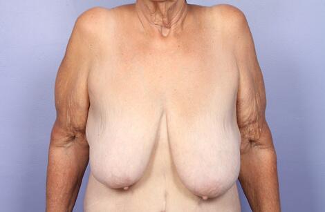 Breast Reduction (for Women) Before & After Image