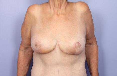 Breast Reduction (for Women) Before & After Image