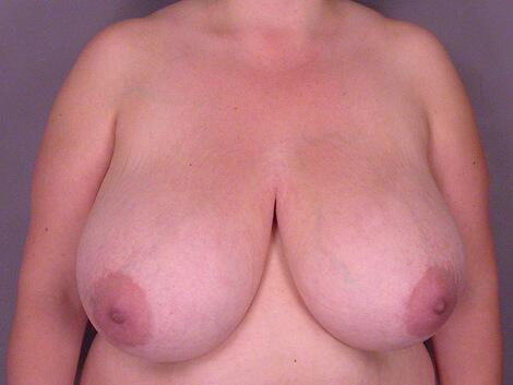 Breast Reduction (for Women) Before & After Image