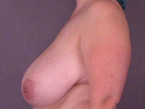 Breast Reduction (for Women) Before & After Image