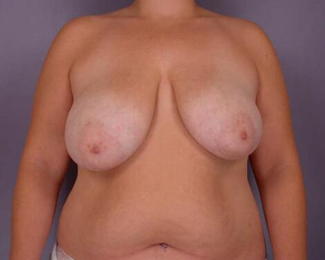 Breast Reduction (for Women) Before & After Image