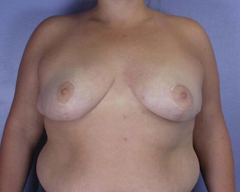 Breast Reduction (for Women) Before & After Image