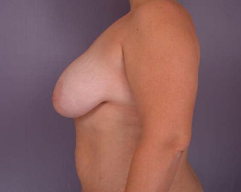 Breast Reduction (for Women) Before & After Image