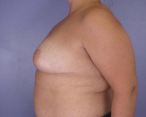 Breast Reduction (for Women) Before & After Image