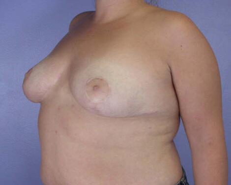 Breast Reduction (for Women) Before & After Image