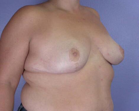 Breast Reduction (for Women) Before & After Image