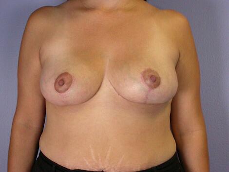 Breast Reduction (for Women) Before & After Image