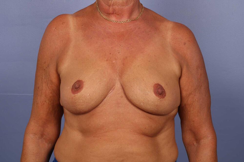 Breast Reduction with Lift Before & After Image