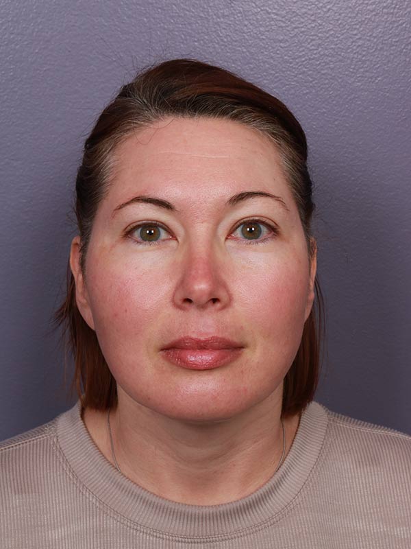 Buccal Fat Removal Before & After Image