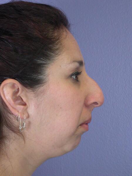 Chin & Cheek Shaping Before & After Image