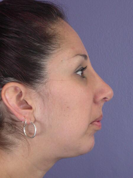 Chin & Cheek Shaping Before & After Image