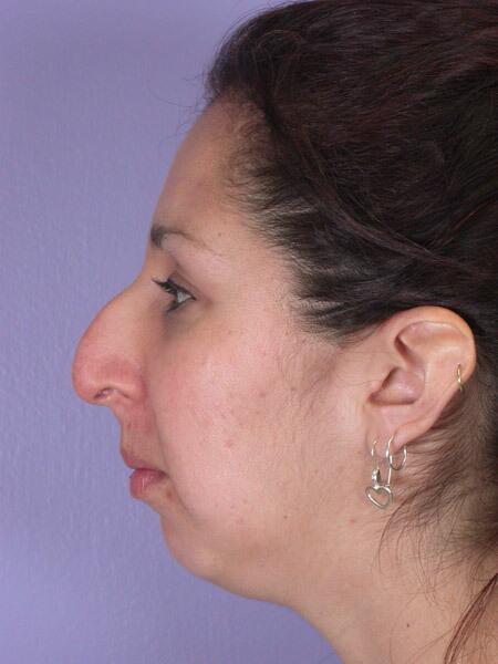 Chin & Cheek Shaping Before & After Image