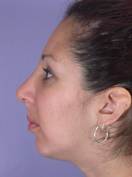 Chin & Cheek Shaping Before & After Image