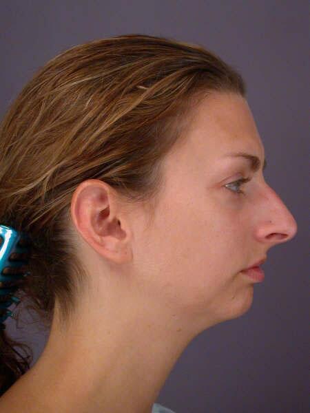 Chin & Cheek Shaping Before & After Image