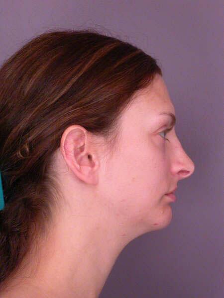 Chin & Cheek Shaping Before & After Image